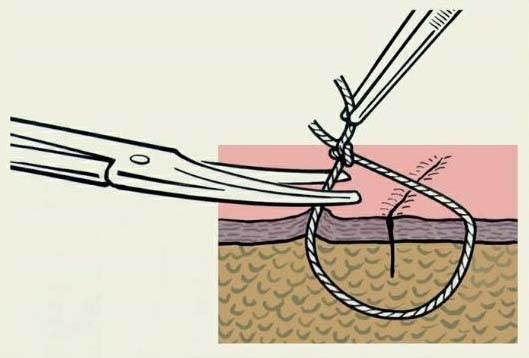 Как снимают швы с десны после имплантации? | Статьи